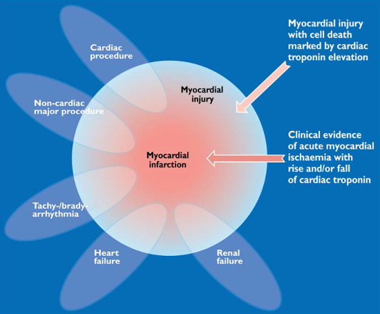 Myocardial injury scenarios